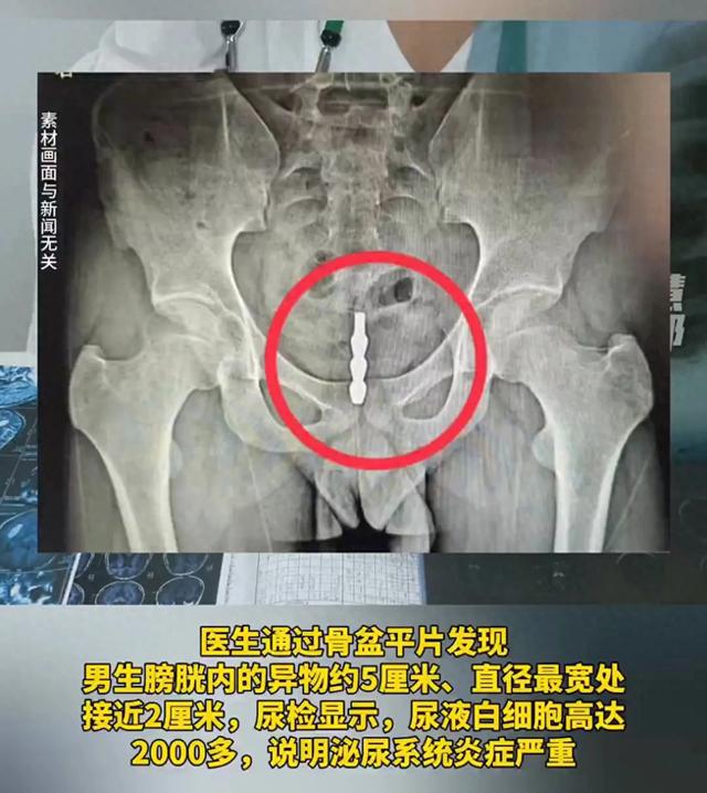福建一大學生將螺旋狀鋼管塞進尿道不料異物一路“溜”進膀胱(圖1)